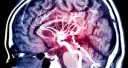 Cerebrovascular Disease
