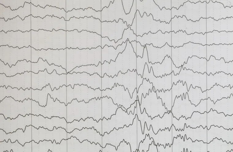 The WFN Teaching Center in Dakar has excellent experience in epilepsy and will train the fellow in all pertinent issues of epilepsy.